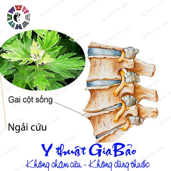 chữa gai cột sống bằng ngải cứu