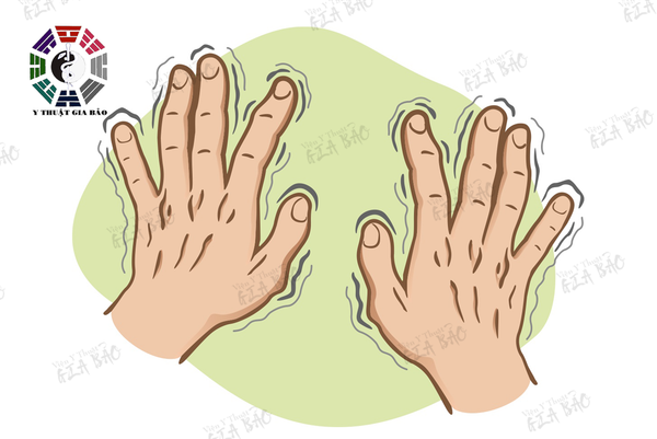 Chứng Chứng run tay là dấu hiệu của một số vấn đề sức khỏe nghiêm trọng như bệnh Parkinson