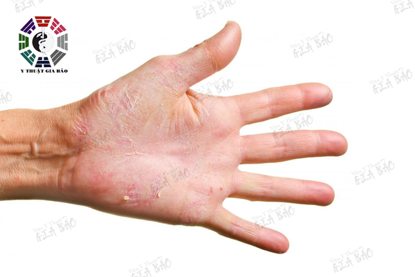 Da bàn tay bị khô là dấu hiệu của hiện tượng mất nước và thiếu hụt estrogen thường xảy ra trong thời kỳ mãn kinh