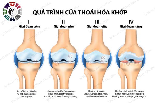 các giai đoạn của viêm khớp gối