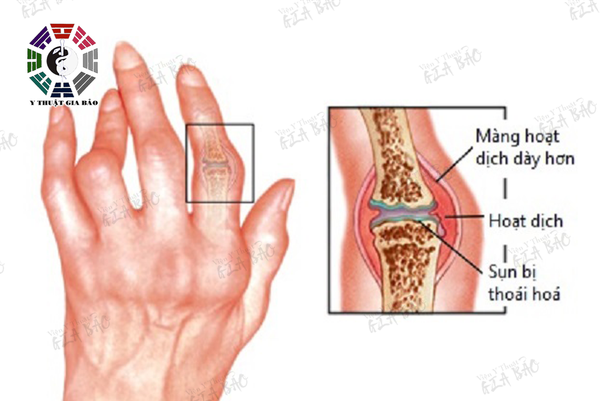 Khớp ngón tay sưng đau và mỏi là triệu chứng của một số bệnh nghiêm trọng như ung thư phổi hoặc bệnh tim