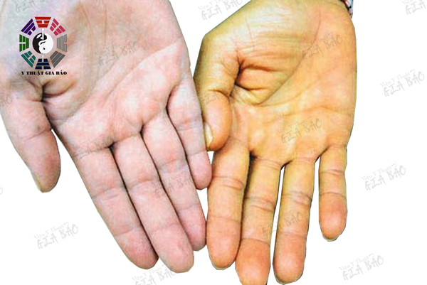 Lòng bàn tay màu vàng là dấu hiệu mắc các bệnh gan, thận 