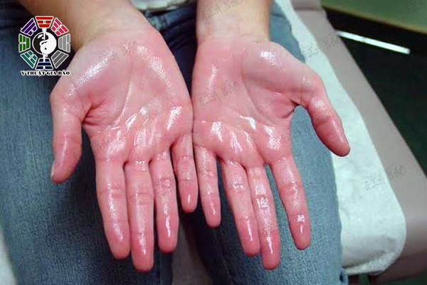 Lòng bàn tay đổ mồ hôi có thể là dấu hiệu của chứng tăng tiết mồ hôi (hyperhidrosis) do rối loạn thần kinh thực vật gây nên