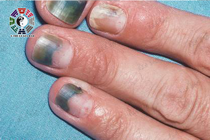 Móng tay có màu xanh lại viền màu đỏ sẫm xung quanh thường là cơ quan bài tiết không bình thường hay bị trúng độc.