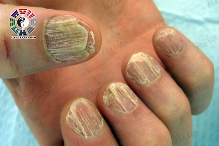 Móng tay yếu hoặc nứt có thể là triệu chứng thiếu kẽm