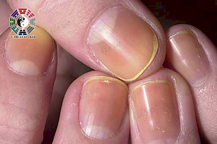 Móng tay có màu vàng thường liên quan tới bệnh gan.