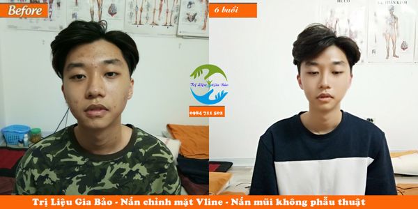 Nắn mũi không phẫu thuật