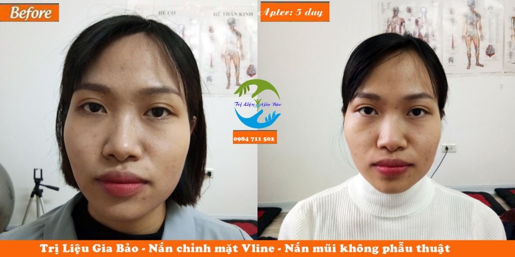 Nắn chỉnh mặt vline, chỉnh lệch hàm, nắn mũi không phẫu thuật