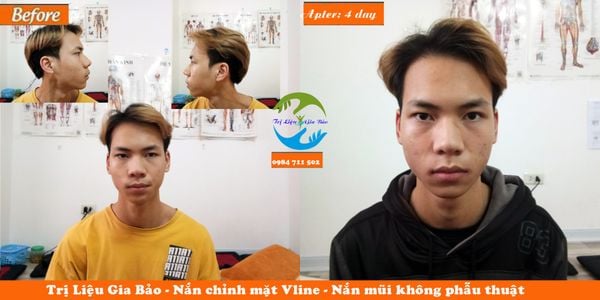 lệch mặt, nắn chỉnh mặt vline