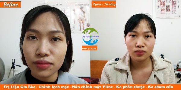 chỉnh lệch mặt, nắn chỉnh mặt vline