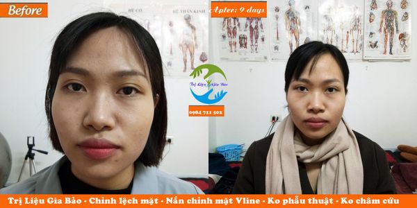 chỉnh lệch mặt, nắn chỉnh mặt vline