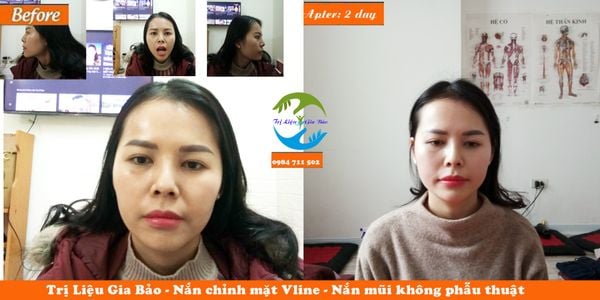 Ảnh chụp nắn chỉnh mặt Vline: trước khi nắn mặt và sau buổi 