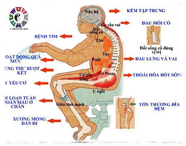 Ngồi lâu sai tư thế có thể gây ung thư trực tràng