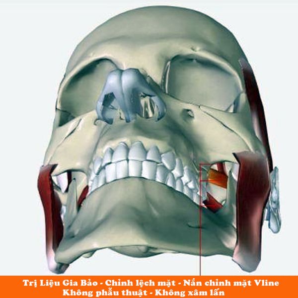 chỉnh lệch hàm không phẫu thuật