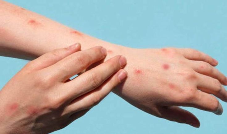 Tê tay hoặc ngứa tay, chân cũng là một dấu hiệu bệnh tiểu đường type2