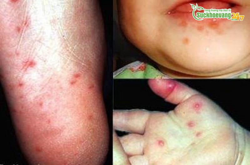 Xuất hiện những dấu hiệu này khi mắc tay chân miệng, cần đến bệnh viện ngay