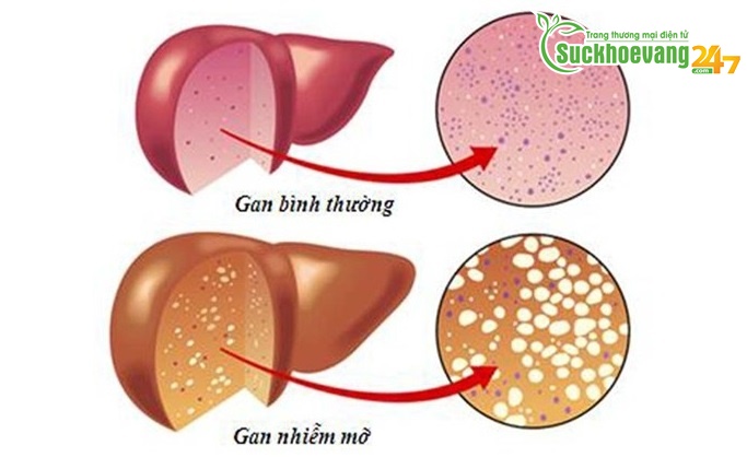 Cảnh báo: Đừng chủ quan với 10 nguy cơ và dấu hiệu bệnh gan