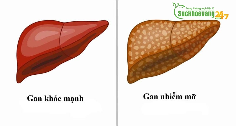 Những thông tin về bệnh gan nhiễm mỡ ít người biết