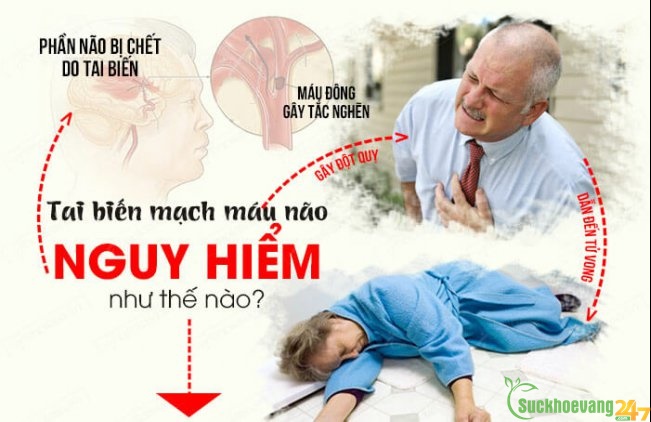 Hãy phòng tránh tai biến mạch máu não