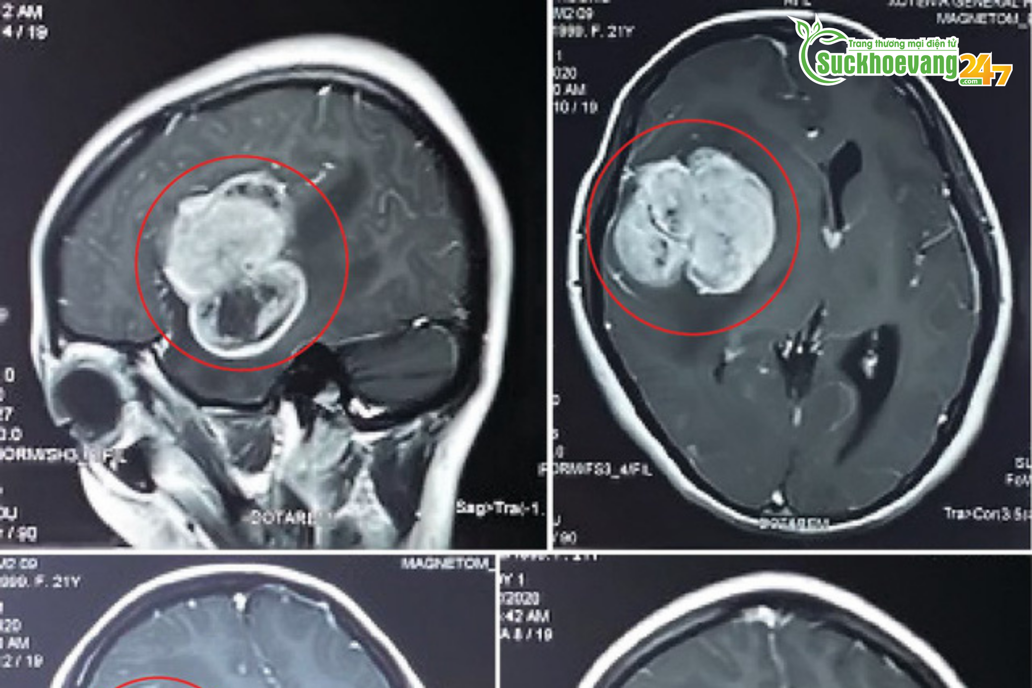 Cô gái trẻ phát hiện u não khổng lồ sau gần 1 tháng bị đau đầu