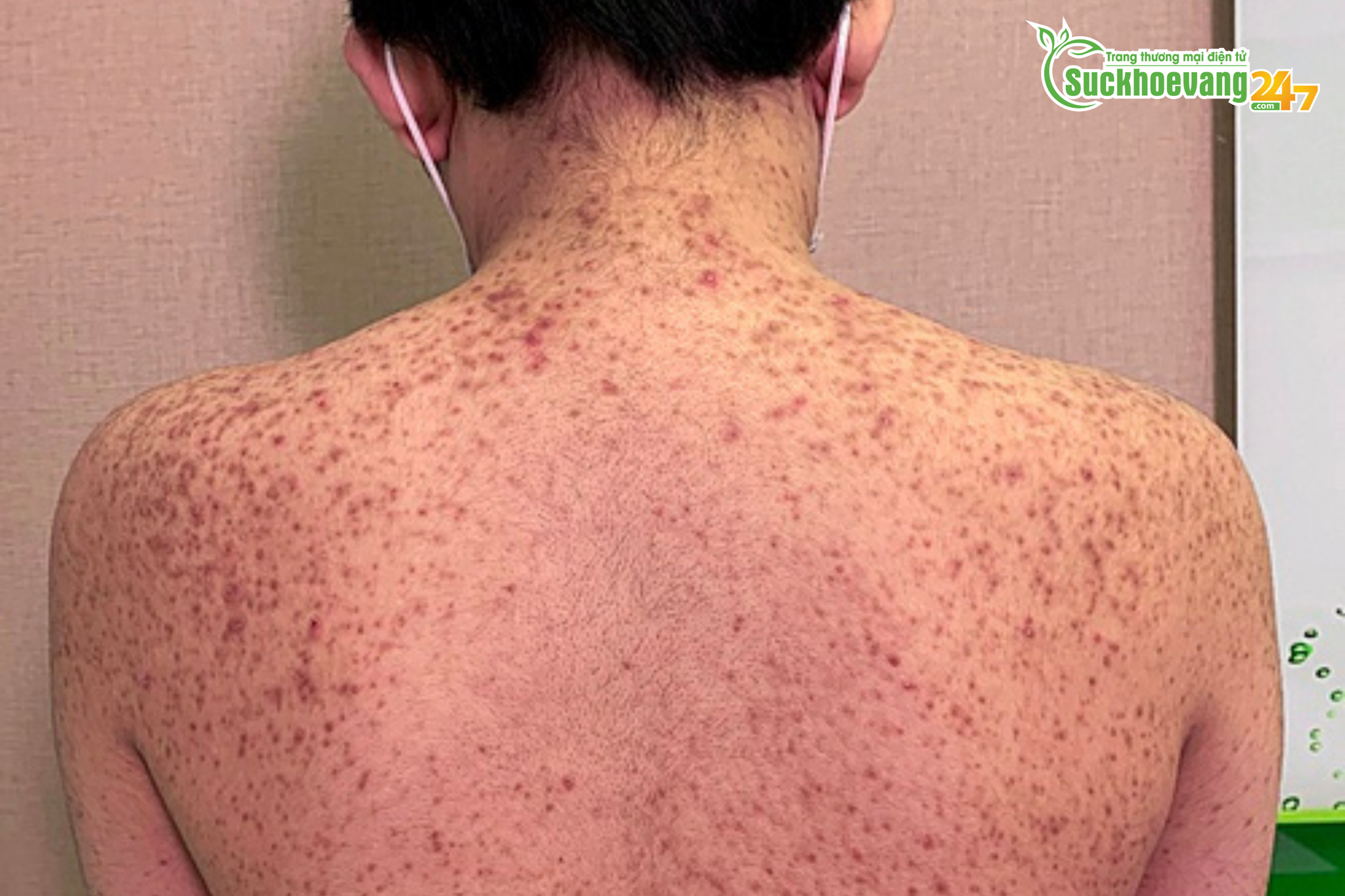 5 người gặp biến chứng do tiêm silicon mua ngoài chợ