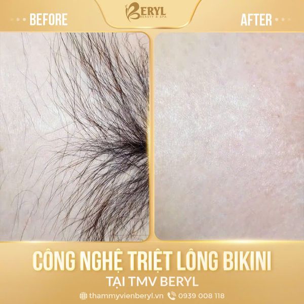 Hình ảnh sau khi triệt lông vùng kín tại Thẩm mỹ viện Beryl