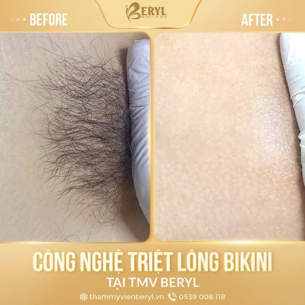 Hình ảnh sau khi triệt lông vùng kín tại Thẩm mỹ viện Beryl
