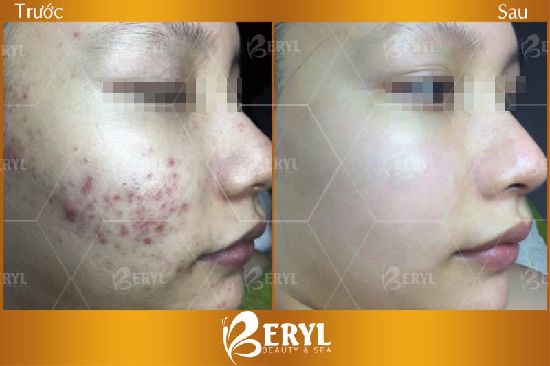 Trước và sau khi điều trị mụn hiệu quả tại Beryl Beauty & Spa.