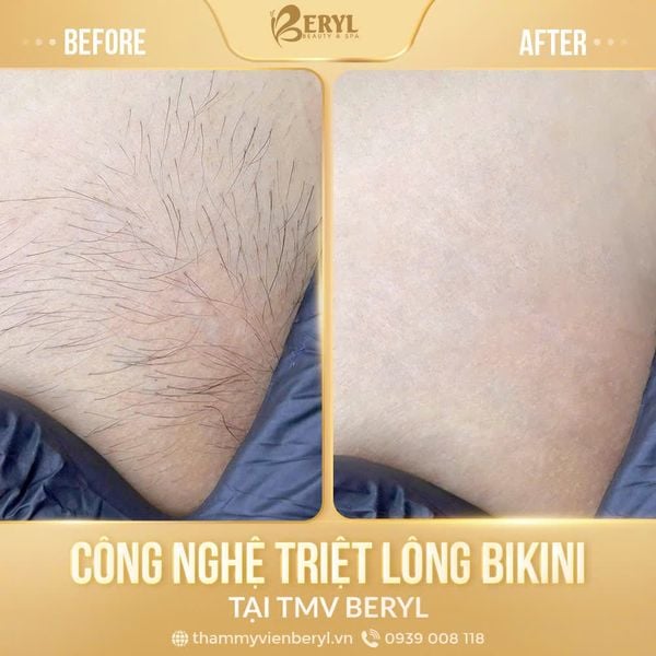 Hình ảnh sau khi triệt lông vùng kín tại Thẩm mỹ viện Beryl