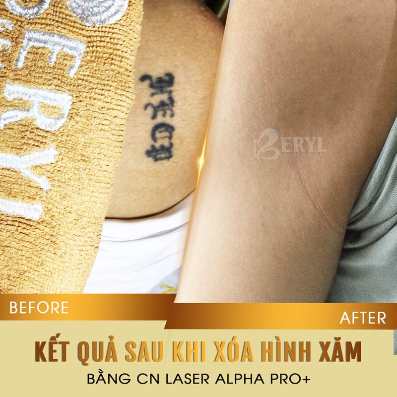 Hình ảnh trước và sau khi xóa xăm bằng Laser Alpha Pro+ tại Beryl Beauty