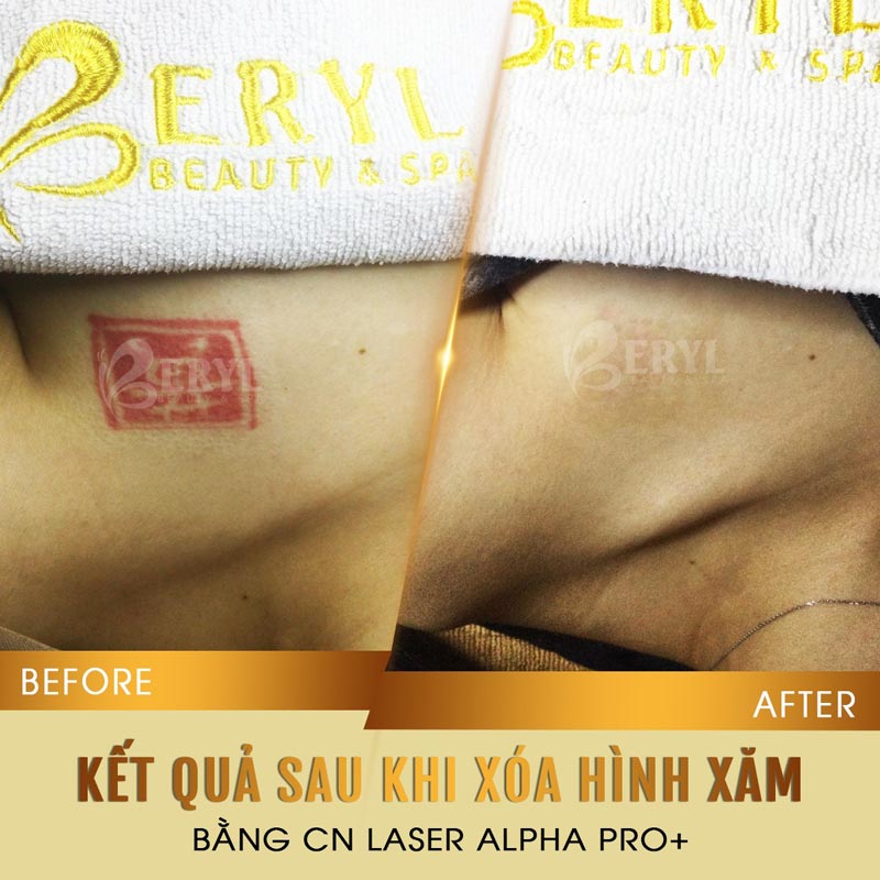 Hình ảnh trước và sau khi xóa xăm bằng Laser Alpha Pro+ tại Beryl Beauty