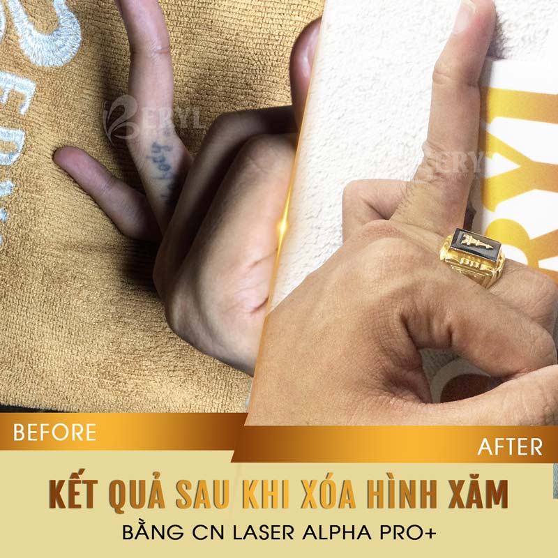 Hình ảnh trước và sau khi xóa xăm bằng Laser Alpha Pro+ tại Beryl Beauty