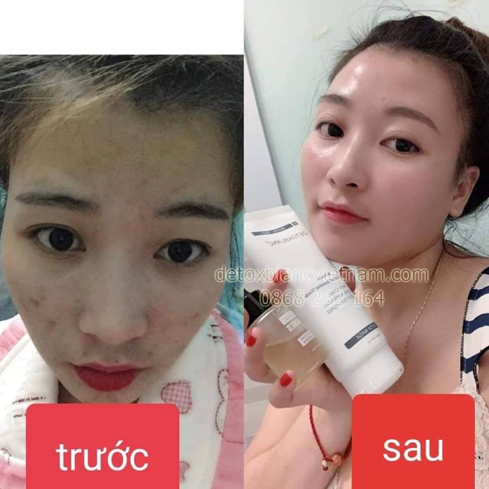 Feedback khách hàng trị mụn với bộ trị mụn dưỡng trắng da Detox BlanC