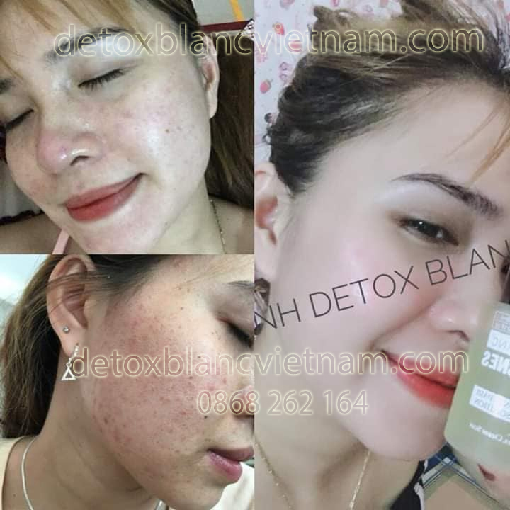 Feedback khách hàng trị mụn với bộ trị mụn dưỡng trắng da Detox BlanC