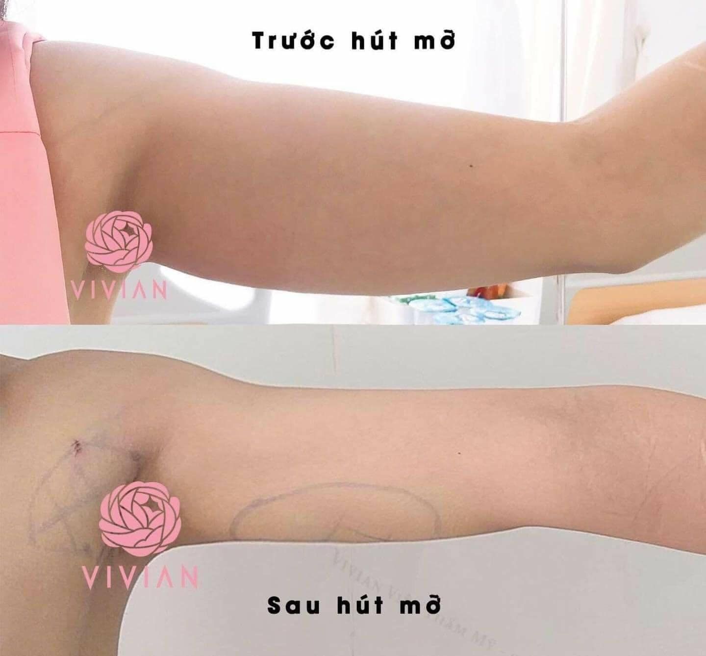 Hút mỡ với công nghệ Lipo Matic 3D