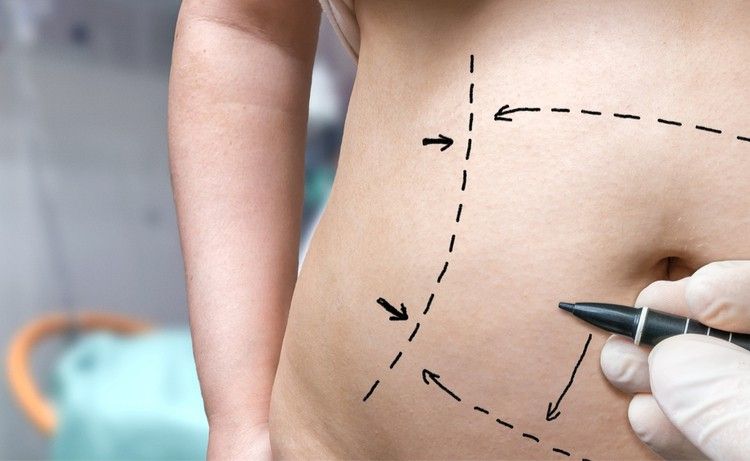 Những điều cần biết về phẫu thuật tạo hình thành bụng