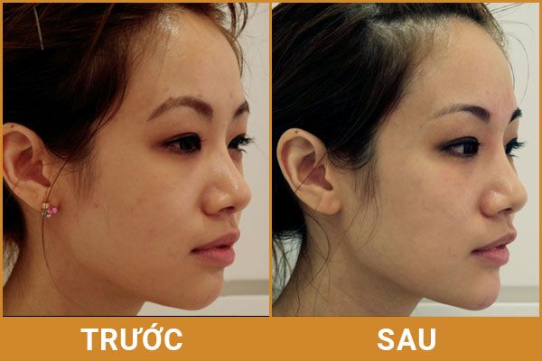 Tiêm chất làm đầy Filler