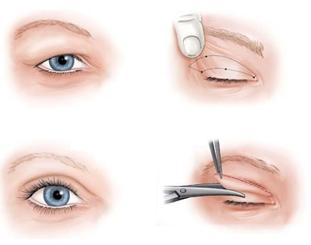 Cách khắc phục mắt một bên 2 mí và một bên 1 mí
