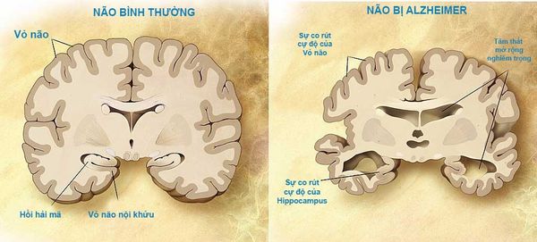 bệnh Alzheimer