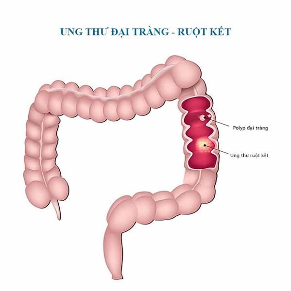 Ung thư đại tràng