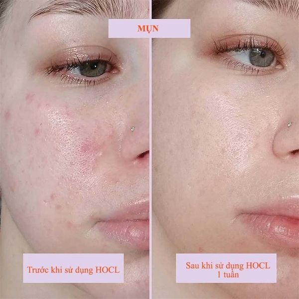 axit hypochlorous HOCL