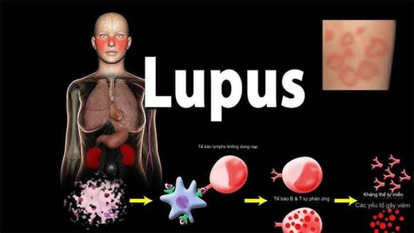 Lupus ban đỏ