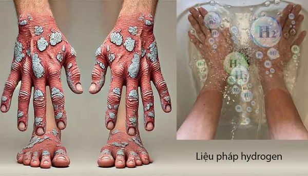 Nước Hydro điều trị vẩy nến