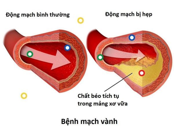 bệnh động mạch vành