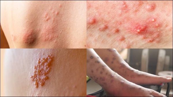 hệ miễn dịch tiểu đường