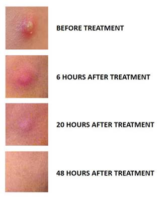 HÔ BIẾN MỤN BỌC TRONG TÍCH TẮC