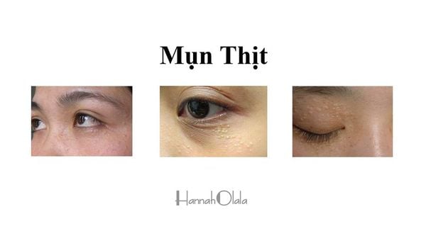 MỤN THỊT