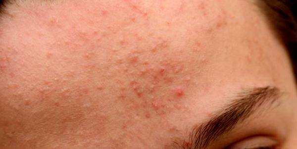 CÁCH TRỊ MỤN ẨN