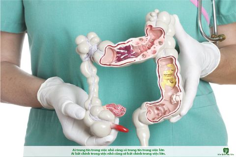 Kiến thức y học cập nhật: Bệnh Crohn - Nguyên nhân, triệu chứng và cách điều trị