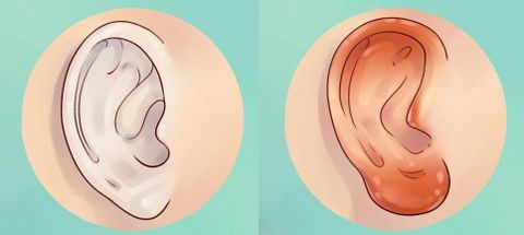 Vá màng nhĩ chữa viêm tai tái diễn?